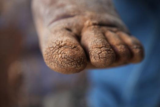 This picture shows the typical moss changes on the toes of a newly arrived patient. The skin can get very sore between these cracks produced by this thickened hard skin which is unable to bend. After a few weeks of regular washing and application of moisturiser as well as wearing socks and shoes these skin changes resolve.